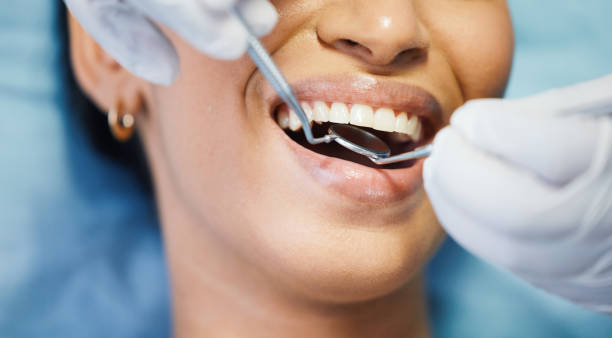 Best Emergency Dental Extractions in Carlyss, LA